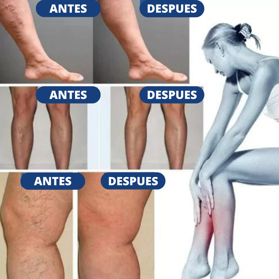 Parche para venas varices